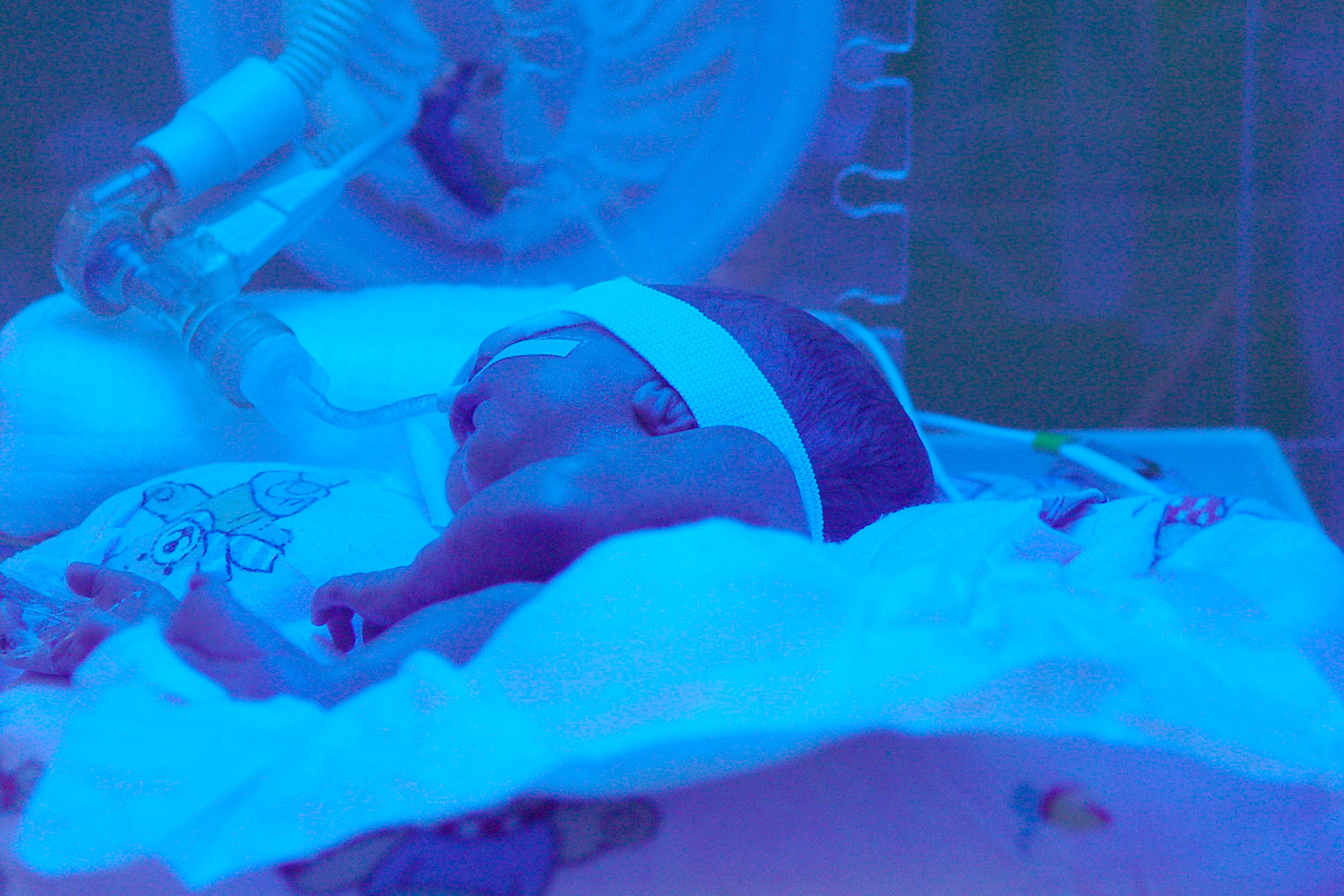 El Supremo aplica el baremo de 2015 para indemnizar la mala praxis en un parto de 2005