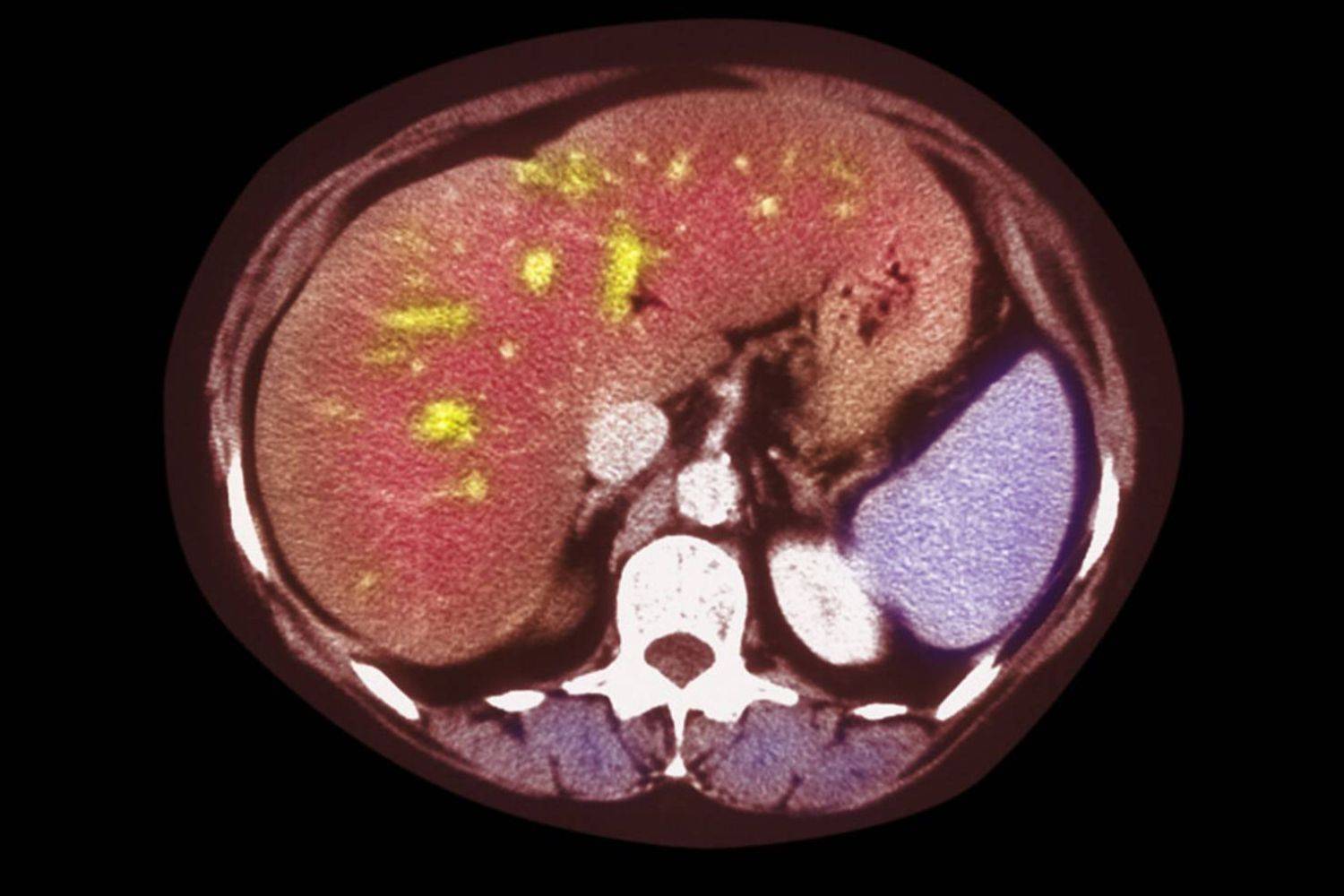Esteatosis hepática metabólica: ¿pesa más el código postal o el genético?