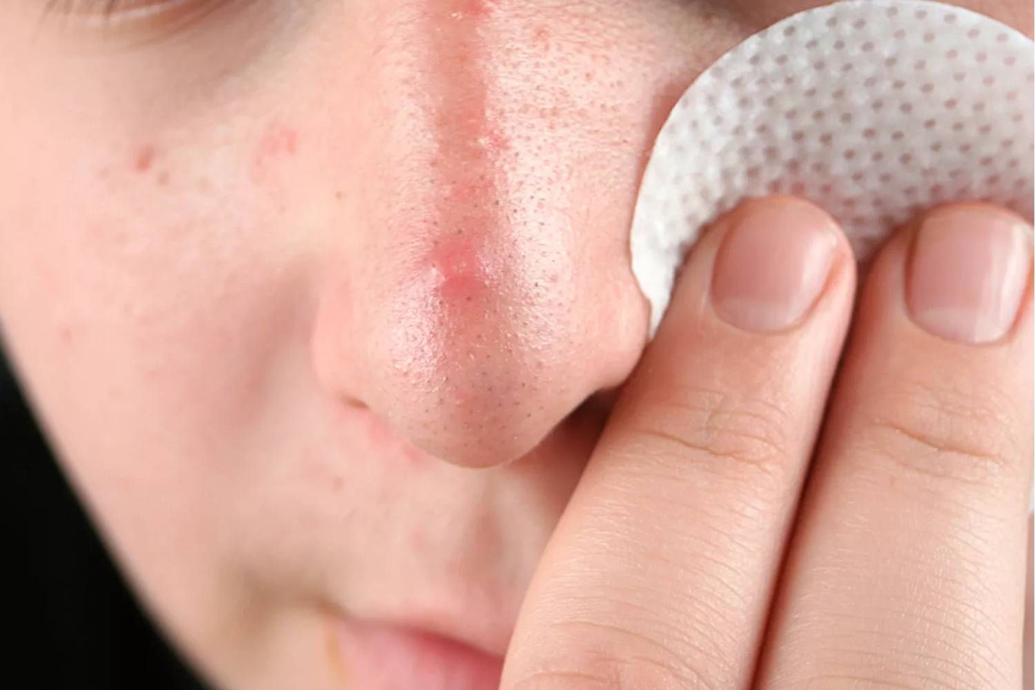 Estos son los medicamentos orales off-label más usados en Dermatología