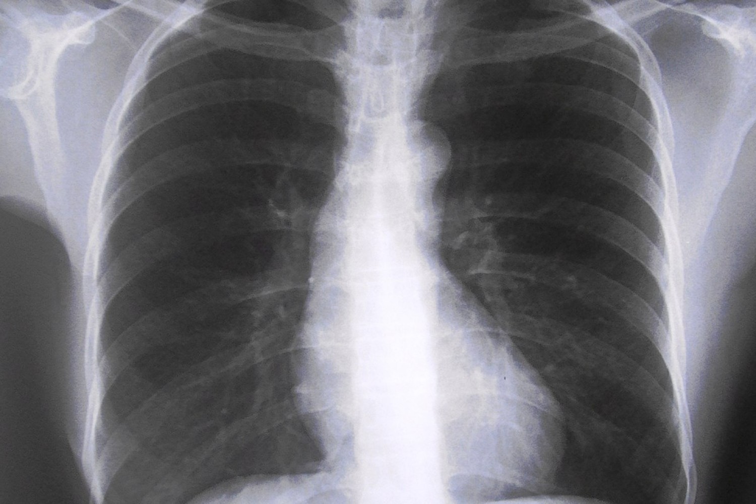 La Comisión Europea aprueba ‘Jascayd’ para fibrosis pulmonar idiopática y progresiva