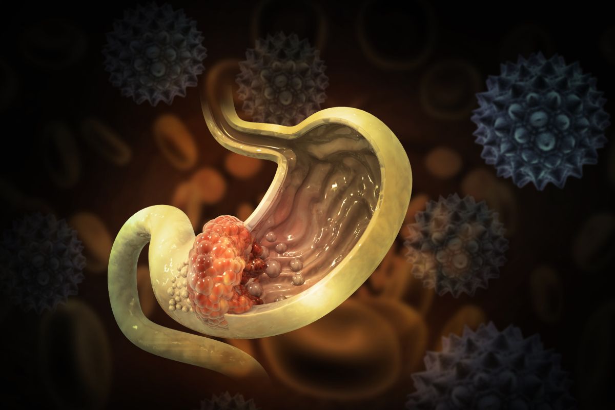 La inmunoterapia podría ser primera línea en cáncer gástrico resecable