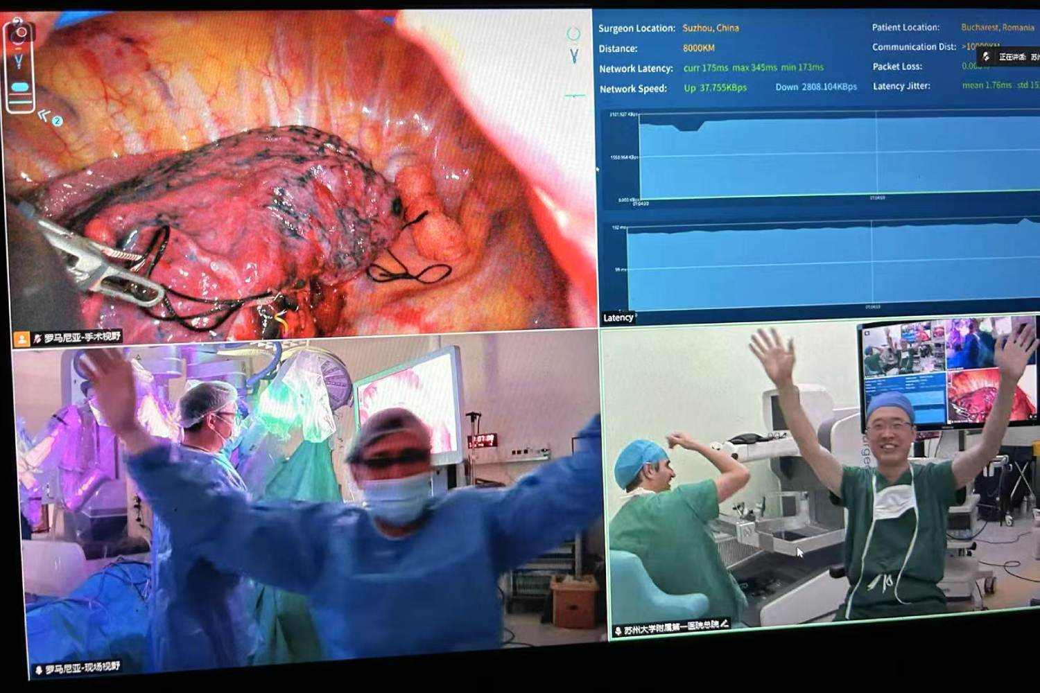 Primera cirugía de cáncer de pulmón transoceánica del mundo