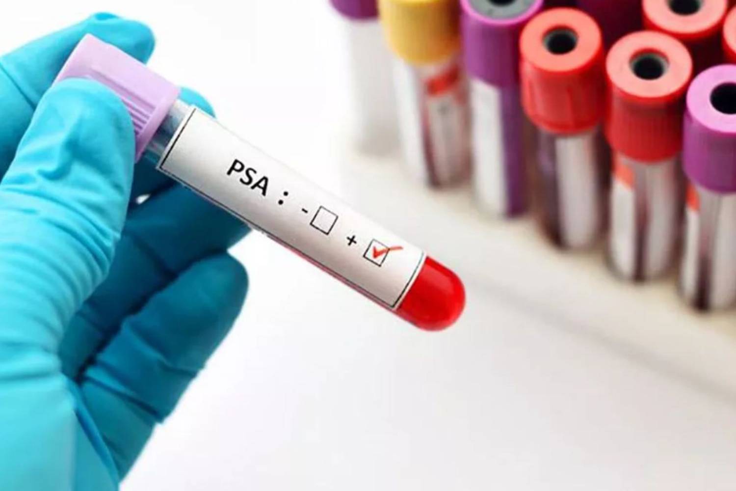 Quitar la etiqueta de «cáncer» al de próstata de grado 1 evitaría 2.500 muertes en EEUU