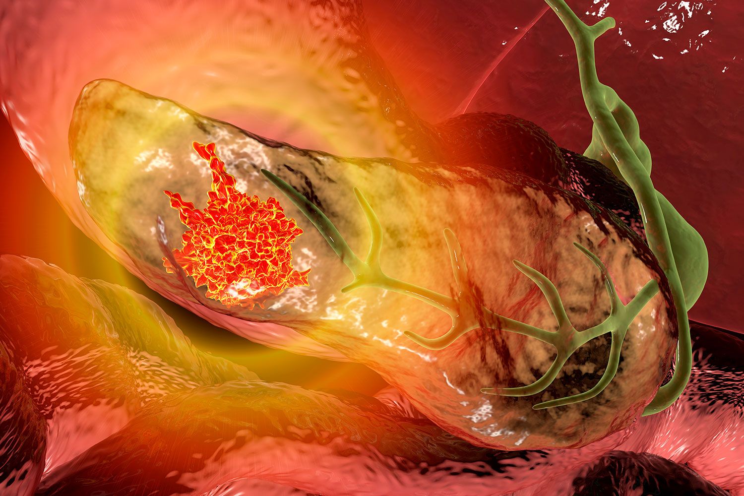 Un inhibidor multi-RAS anticipa un cambio de paradigma en páncreas metastásico