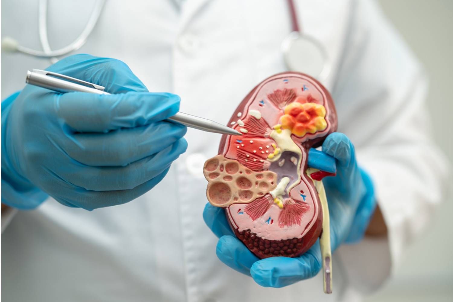 Vía libre de la FDA al primer fármaco para glomeruloesclerosis segmentaria focal